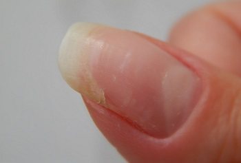 Сломанный с края ноготь
